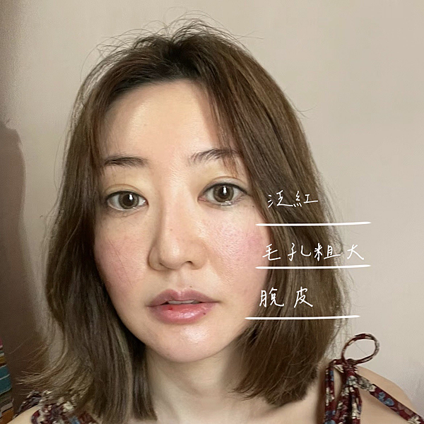 敏感肌夏天泛紅(酒糟肌)保養推薦