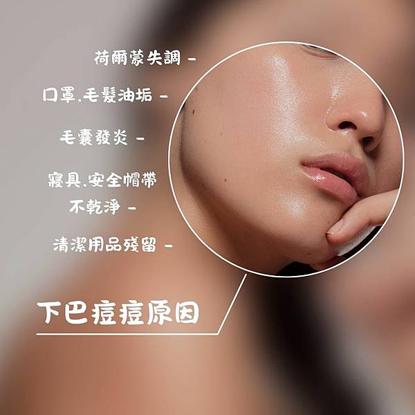 淡痘疤保養ATLA肌密能量水評價 下巴長痘痘的原因