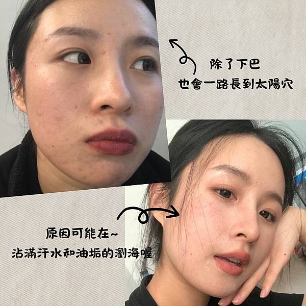 淡痘疤保養ATLA肌密能量水評價 下巴長痘痘的原因