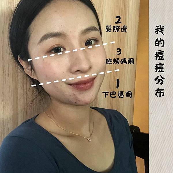 我的痘痘怎麼都長在下巴？