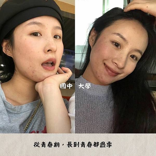 痘痘前後對比 我的痘痘怎麼都長在下巴?