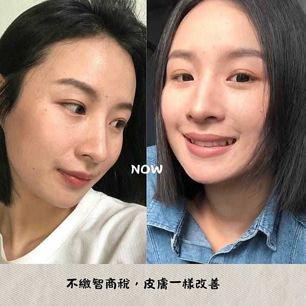 痘痘前後對比 我的痘痘怎麼都長在下巴?