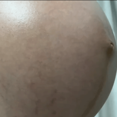 都市傳說|懷男生皮膚變差是真的嗎？懷孕長痘痘怎麼辦？擦的淨膚