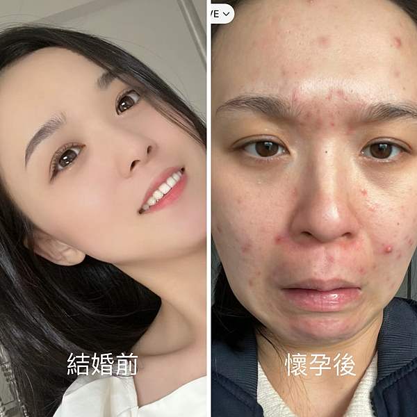 都市傳說|懷男生皮膚變差是真的嗎？懷孕長痘痘怎麼辦？擦的淨膚