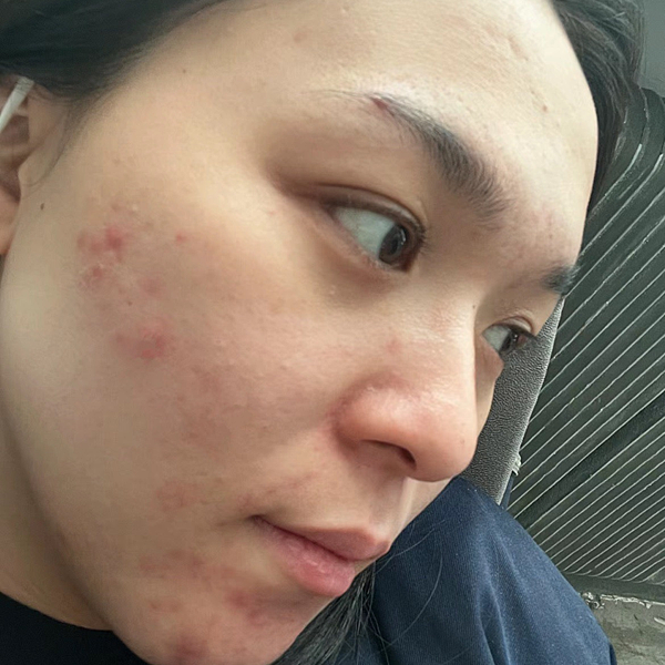 痘痘前後對比