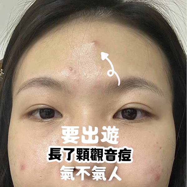 出國旅遊~長了顆大痘痘分享應對出國保養痘痘撇