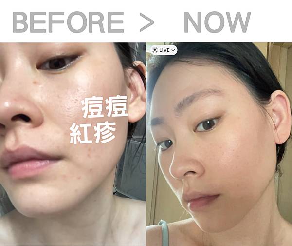 換季熱潮紅前後對比