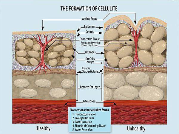 Formation of Cellulite 