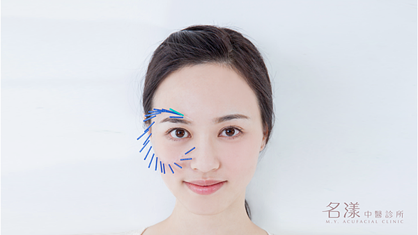 針灸美顏會痛嗎 號稱 比髮絲更細 日本清鈴針灸讓妳不知痛為而物 名漾中醫診所 痞客邦