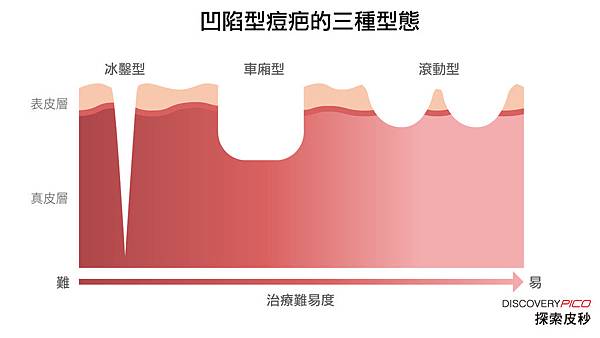 探索-凹疤型態.jpg