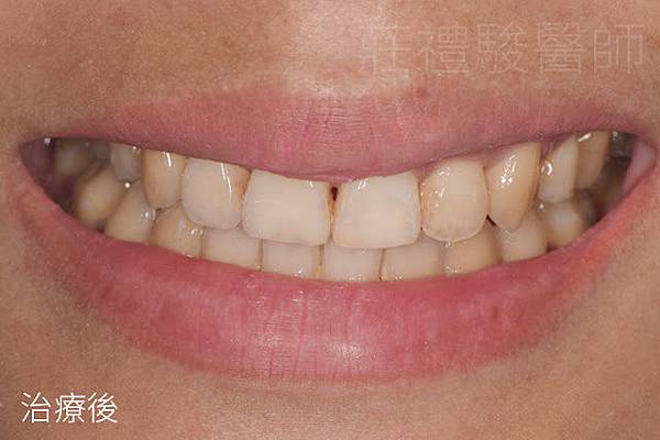 根管治療抽神經後的門牙變黑牙齒變色 齒內美白輕鬆拯救 推薦台中牙醫生活牙醫診所 台中生活牙醫診所 痞客邦