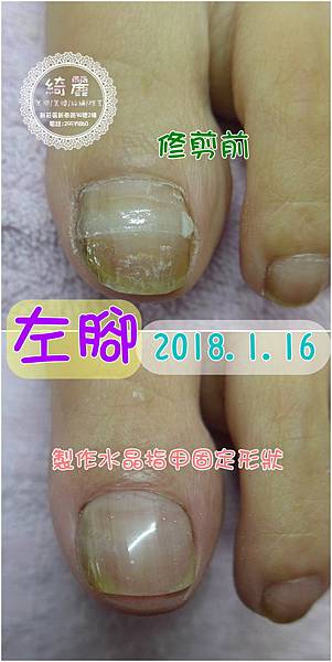 第六次左腳水晶.jpg