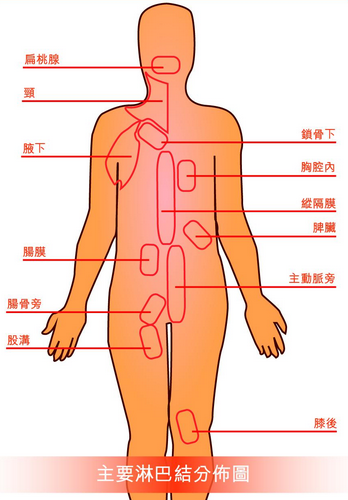 淋巴腺癌治療