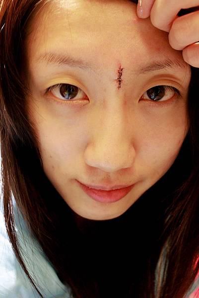 邀稿 祕密大公開我的除痣手術紀錄 花漾醫美診所 Hola You Bai 痞客邦