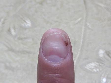 指甲瘀血復原心路歷程 Eternal 永遠 痞客邦