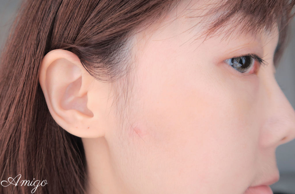 Acnes 抗菌痘痘貼