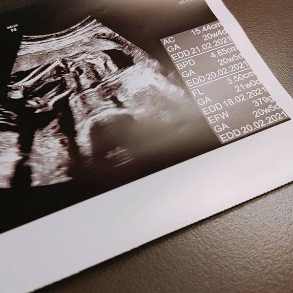 懷孕胎兒超音波照20週