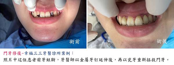 前牙修復-幸福三三牙醫診所.jpg