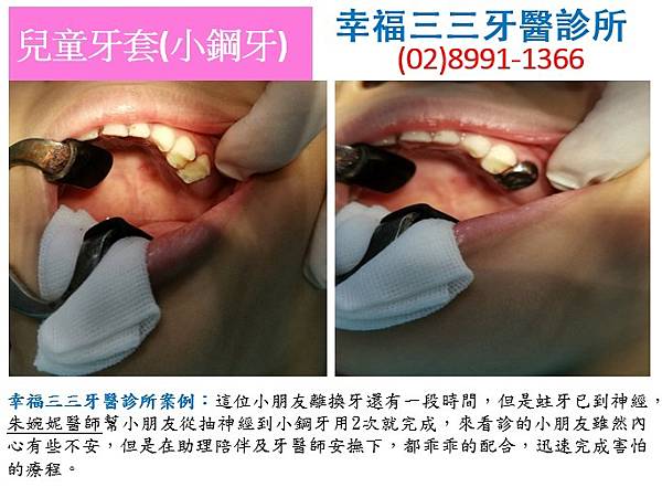 小鋼牙.jpg