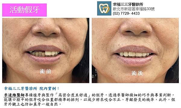 幸福三三-活動假牙.jpg