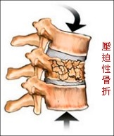 壓迫性骨折.jpg