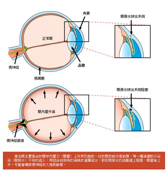 11_青光眼成因.jpg