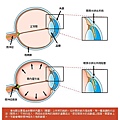 哈佛眼科_11_青光眼成因.jpg