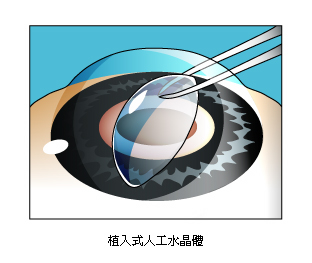 哈佛眼科_35_植入式人工水晶體.jpg