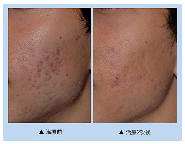 picosure acne scar2