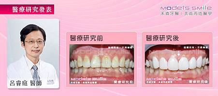 【台北牙醫星鑽超薄瓷牙貼片案例】專業、快速、安全療程 打造上班族完美齒型