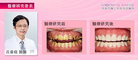 【台北牙醫星鑽超薄瓷牙貼片案例】貼片改善劣齒黃板牙 父女一同打造白淨微笑曲線