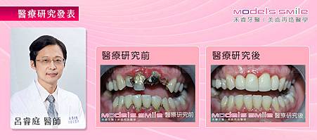 【台北牙醫星鑽全瓷冠案例】蛀牙拖延齒爛又傷身 自然全瓷冠拯救少女笑容