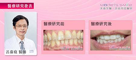 【台北牙醫星鑽超薄瓷牙貼片案例】汙垢影響衛生觀感 貼片美白迅速效果佳