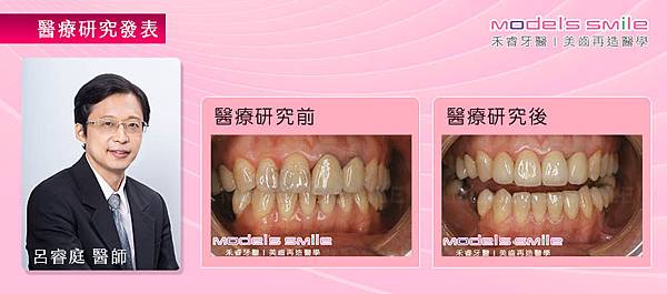 【台北牙醫 全瓷冠 牙齒美白 牙齒美容實例】劣金屬瓷牙毀牙齦肉 星鑽全瓷冠重塑如真牙般自然