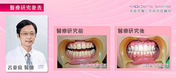 【台北牙醫 星鑽超薄瓷牙貼片案例】 矯正後內縮泛黃 超薄瓷牙貼片完成少女的天使微笑