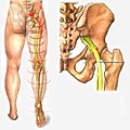 坐骨神經痛