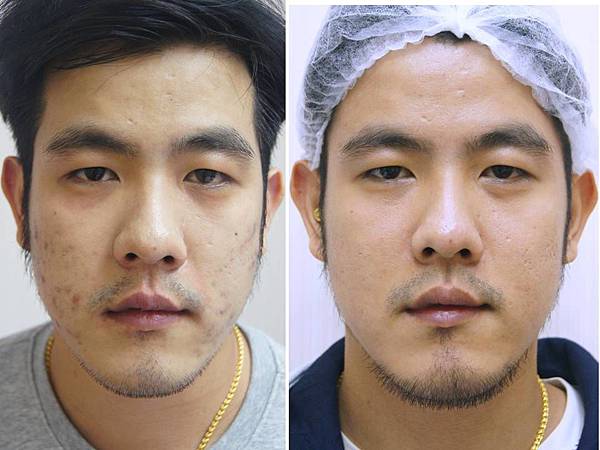 ACNE.jpg ACNE.jpg