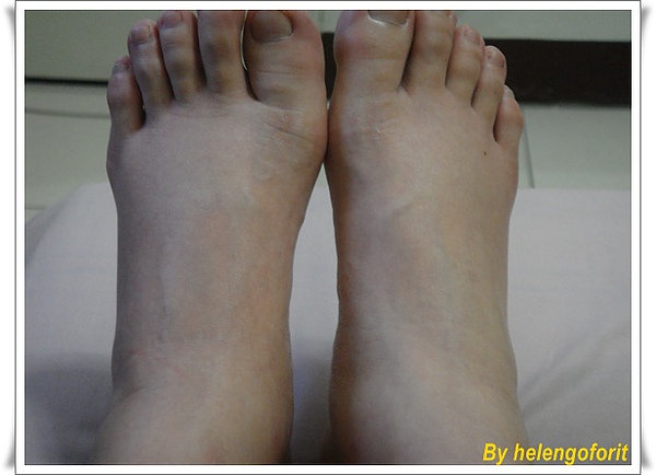swollen feet.jpg