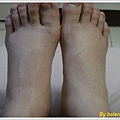 swollen feet.jpg