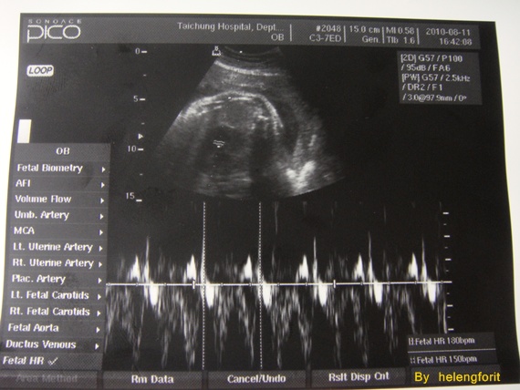 w37 d3 baby scan-heartbeat.jpg