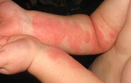 eczema-on-arm eczema-on-arm