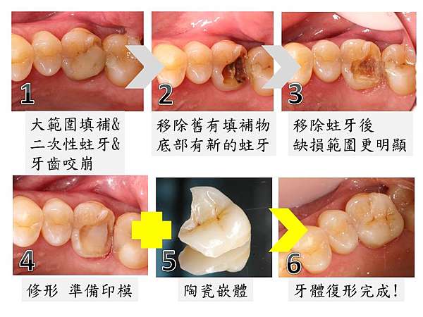 淺談牙齒復形高雄牙醫推薦 赫品牙醫診所的部落格 痞客邦