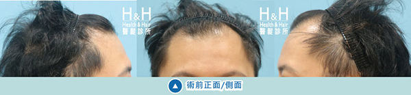 植髮-劉醫師-7-小圖.jpg 植髮-劉醫師-7-小圖.jpg