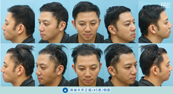 植髮-劉醫師-10.jpg 植髮-劉醫師-10.jpg
