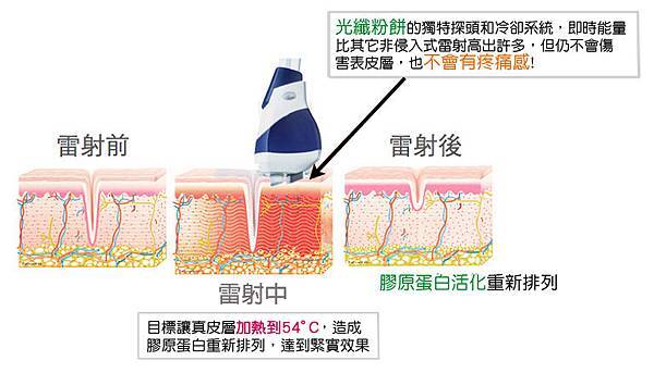 杏仁酸換膚光纖粉餅雷射粉刺痘痘痘疤毛孔粗大出油04.jpg