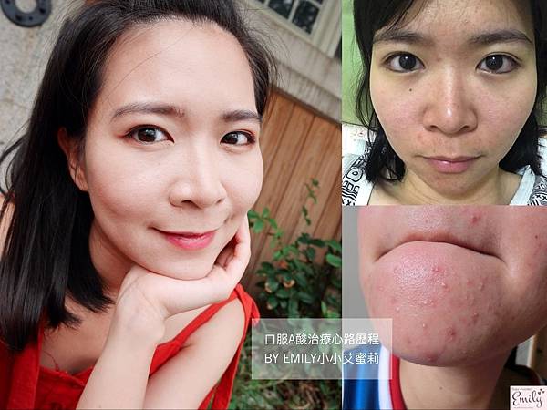保養 成功拯救爛臉 口服a酸治療心路歷程粉刺 痘痘掰掰囉 小小艾蜜莉 痞客邦
