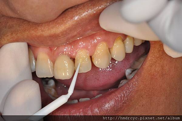 [蛀牙填補] 蛀牙治療步驟 填補蛀牙 高雄牙醫 蛀牙填補推薦