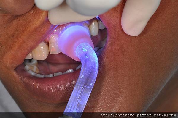 [蛀牙填補] 蛀牙治療步驟 填補蛀牙 高雄牙醫 蛀牙填補推薦
