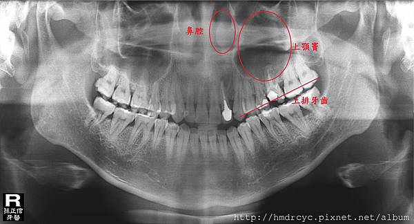 上顎竇1.jpg