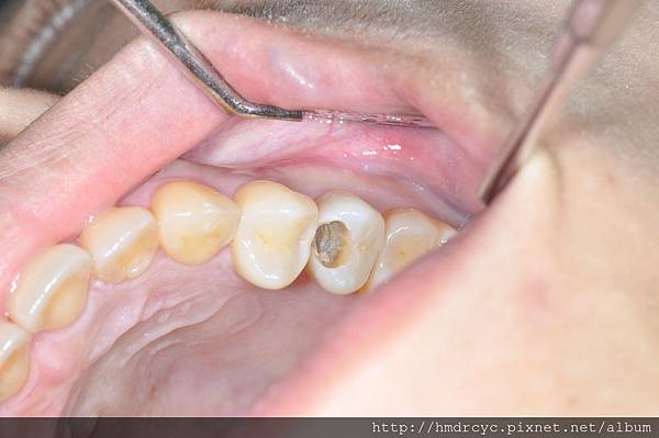 [蛀牙填補] 補蛀牙之前不會痛 為什麼補完反而會痛? 高雄牙